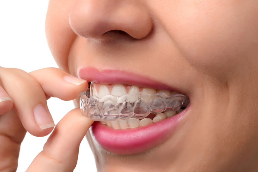 , <strong>Top Benefits of Wearing Invisible Braces</strong>