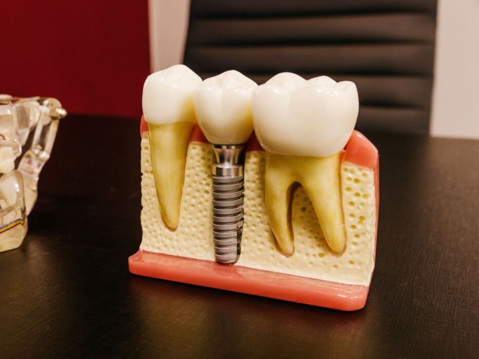 Dental Crowns