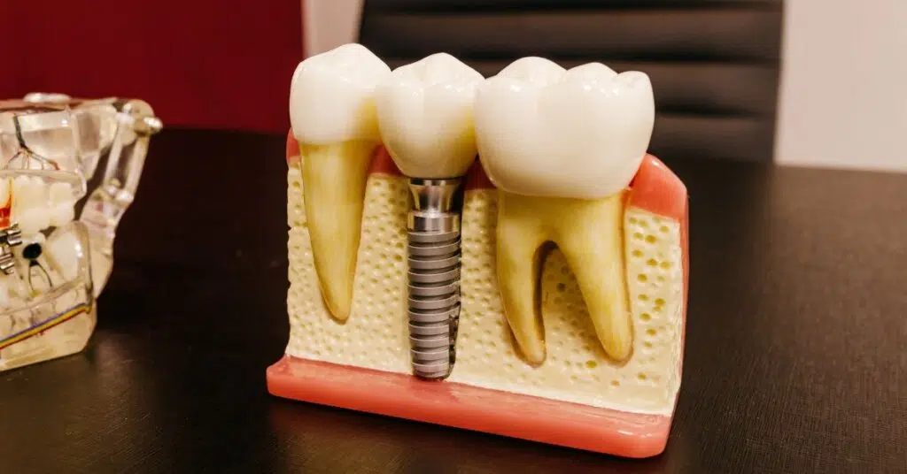 Dental Crowns