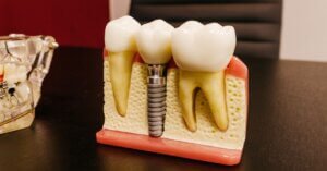 Dental Crowns