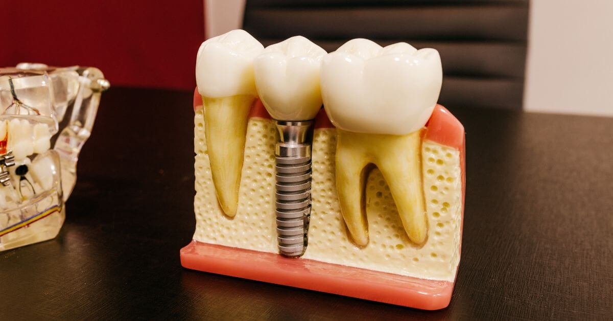 Dental Crowns