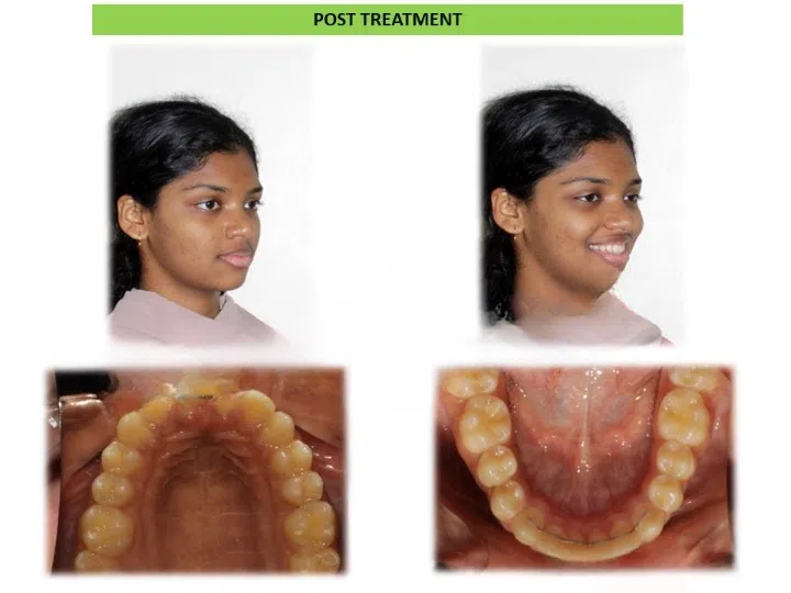 Pre and post comparison