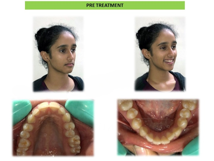 Pre and post comparison