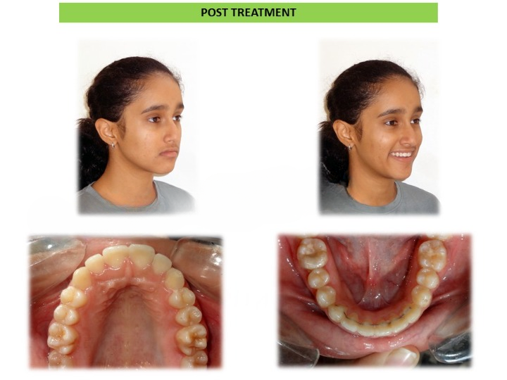 Pre and post comparison