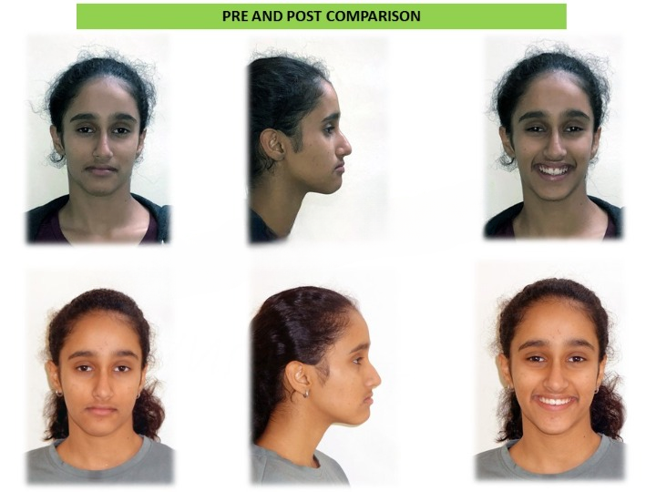 Pre and post comparison