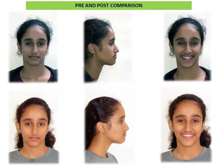 Pre and post comparison