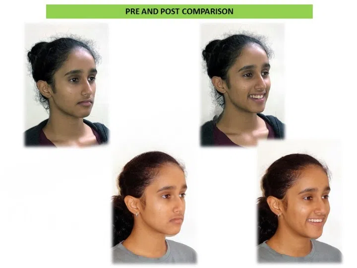 Pre and post comparison