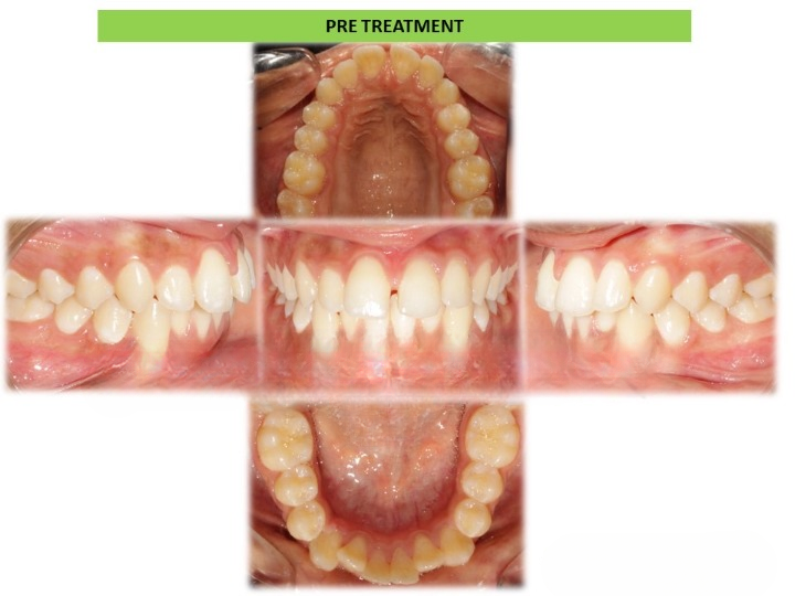 Pre and post comparison