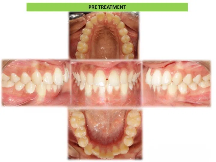 Pre and post comparison