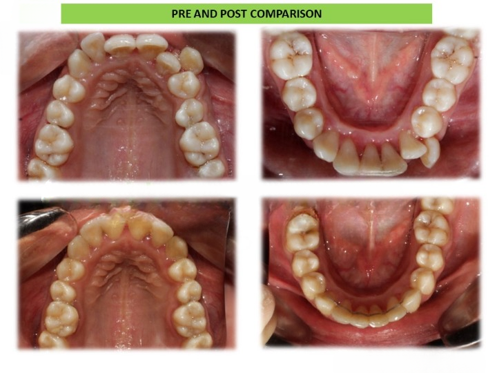 Pre and post comparison 4