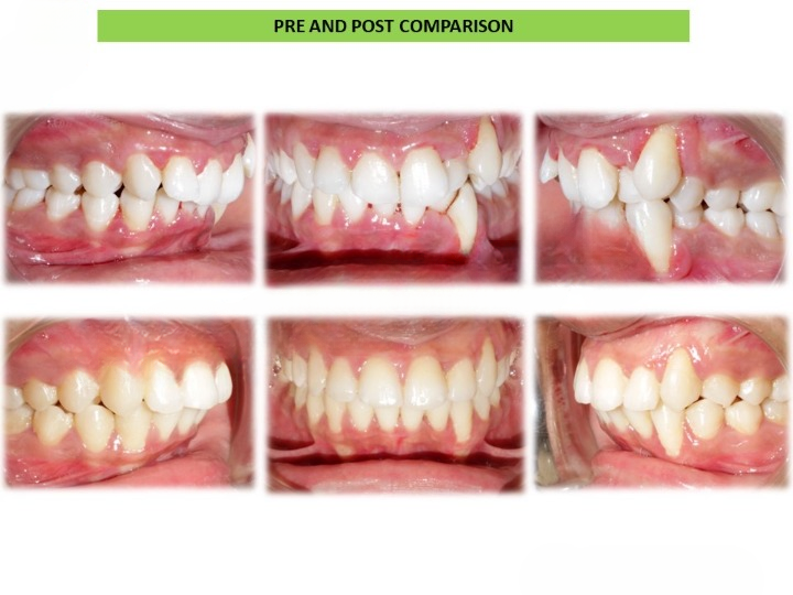 Pre and post comparison 5