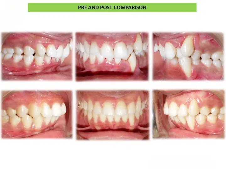 Pre and post comparison 5