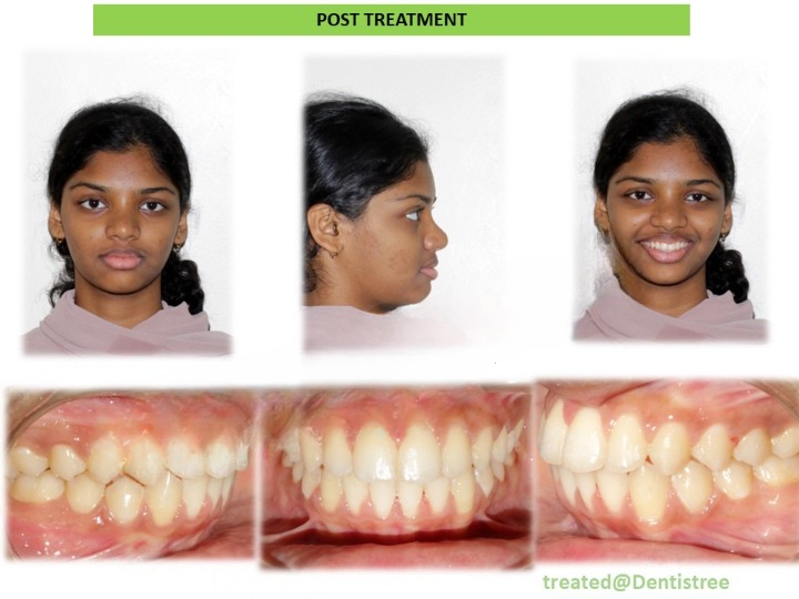 Pre and post comparison 9