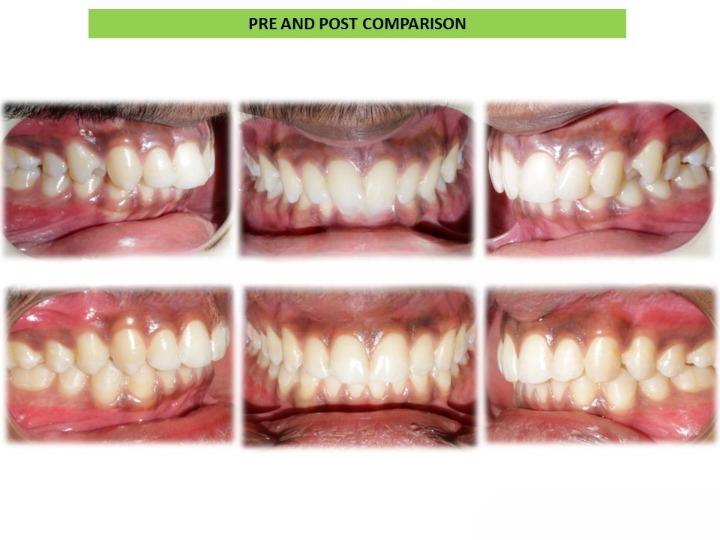 Pre and post comparison