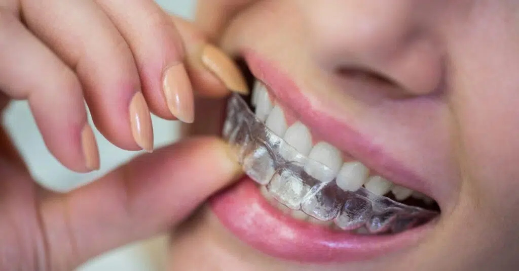 What Makes Invisalign Different from Braces
