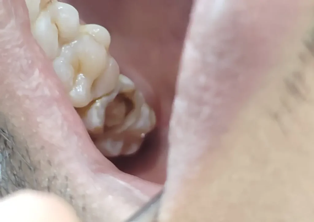 Root Canal Treatment Case Study
