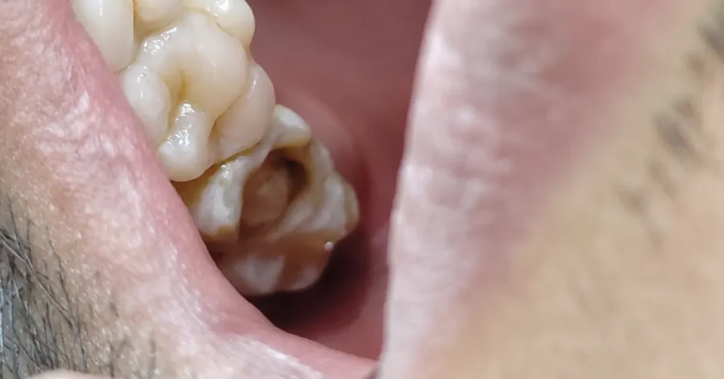 Root Canal Treatment Case Study