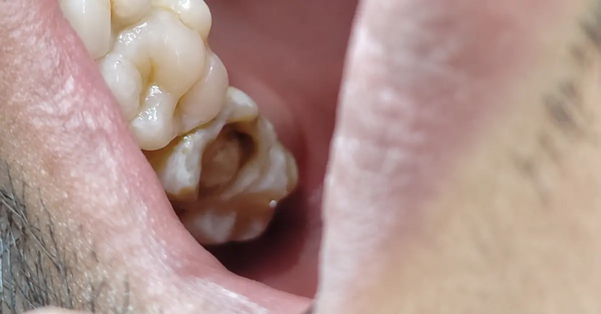 Root Canal Treatment Case Study