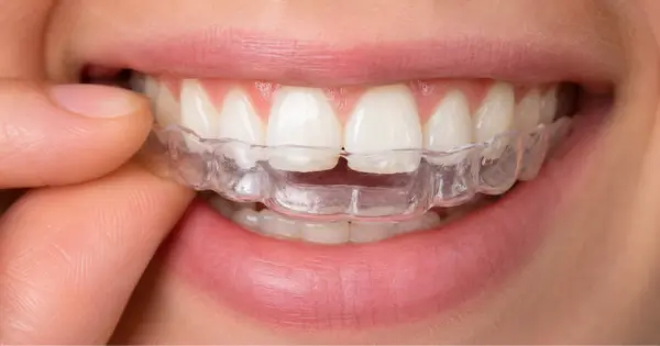 Invisalign Not Tracking?