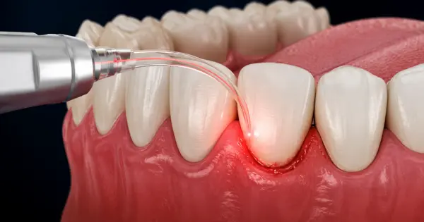 Can Laser Dentistry Treat Bleeding Gums?