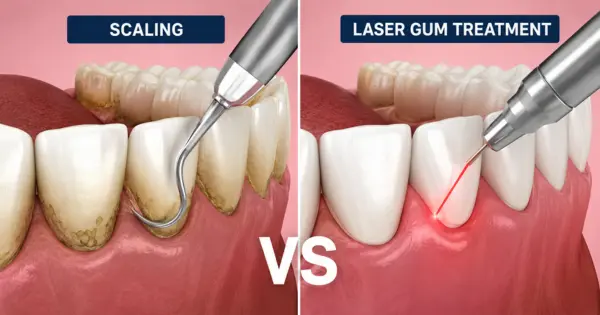 Laser Gum Treatment vs Scaling