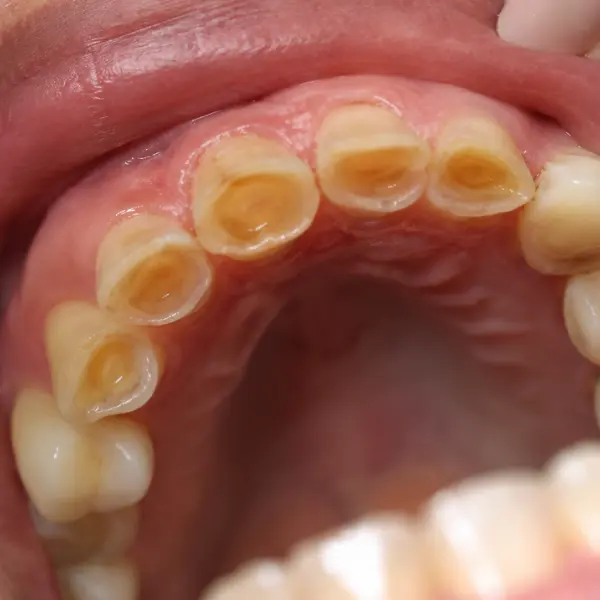 real teeth grinding affected tooth