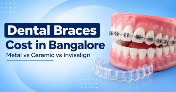 Dental Braces Cost in Bangalore