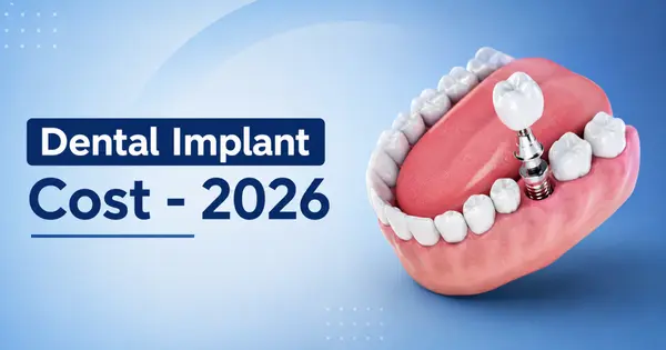 Dental Implant Cost in Bangalore – 2026