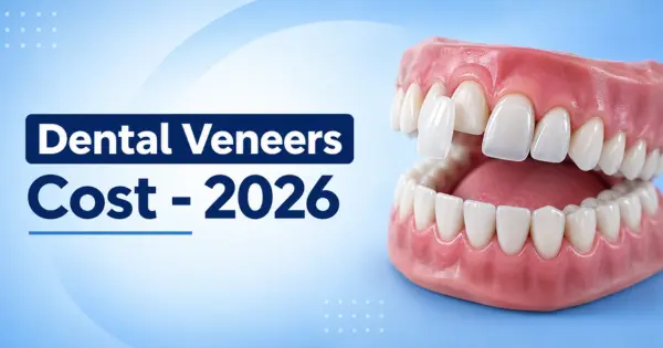 Dental Veneers Cost in Bangalore