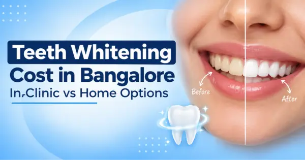 Teeth Whitening Cost in Bangalore